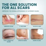Medical Grade Silicone Scar Tape Professional Scar Removal - Image 2